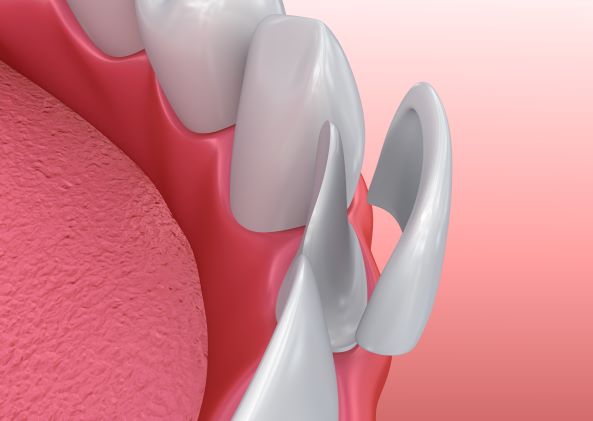 graphic of veneer placement