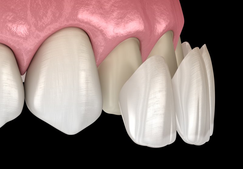 porcelain veneers